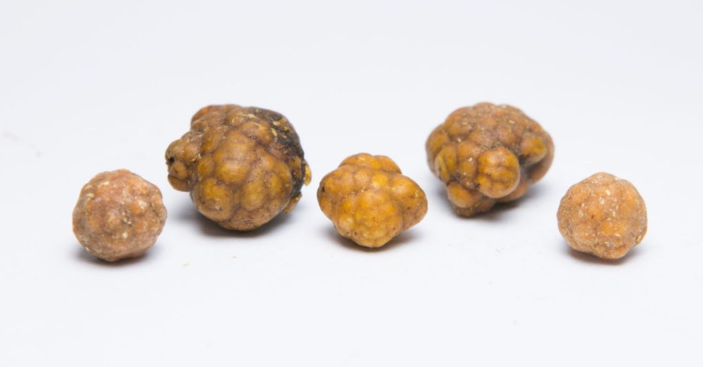 What is Gallbladder Stone?