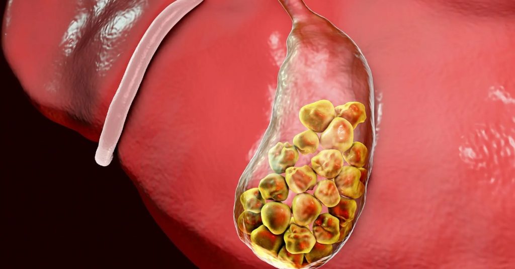 Causes of Gallbladder Stone