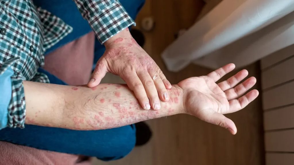 क्या गाठिया में बुखार खतरनाक है