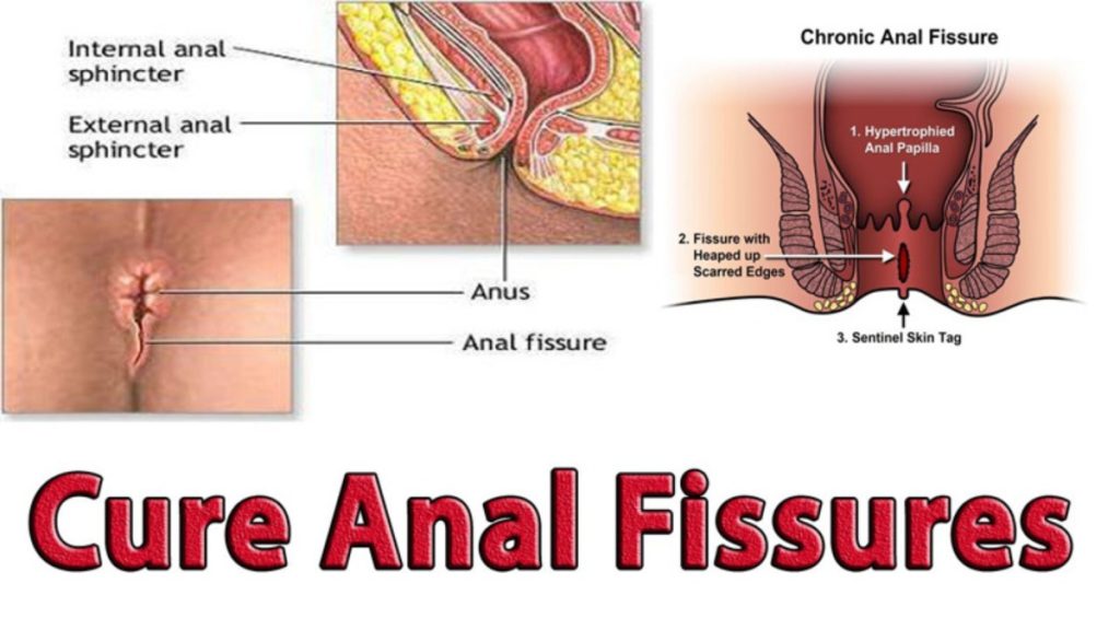 Anal Fissure को ठीक करने का सबसे तेज़ तरीका क्या है