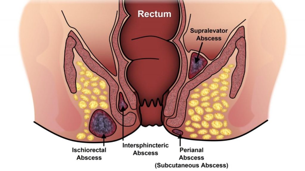 भगंदर क्या है (What is Fistula in Ano)