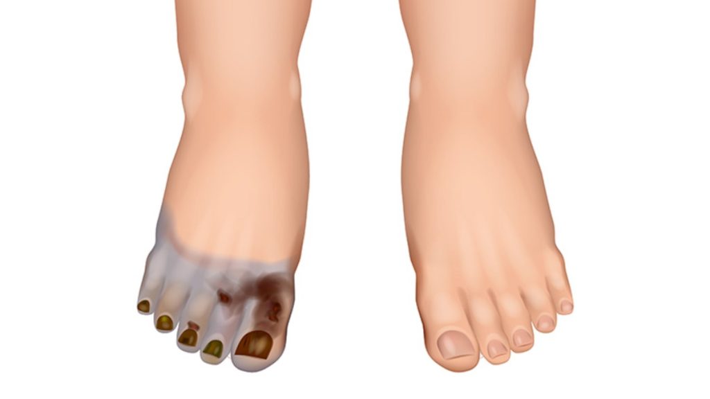 Gangrene के प्रकार