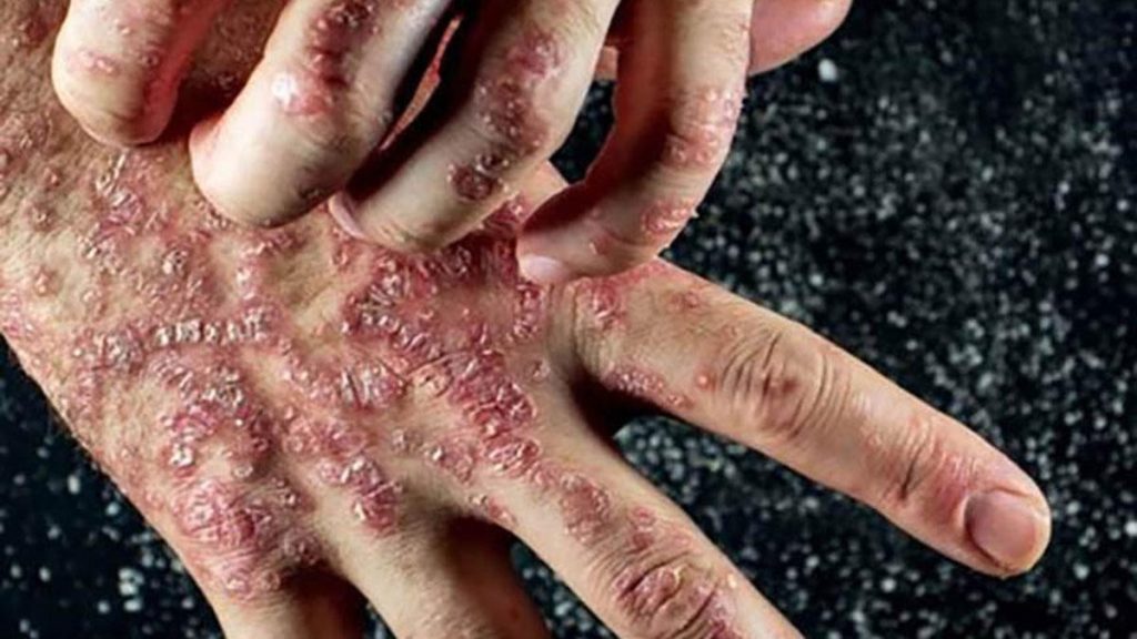 आयुर्वेद के अनुसार Autoimmune Disease