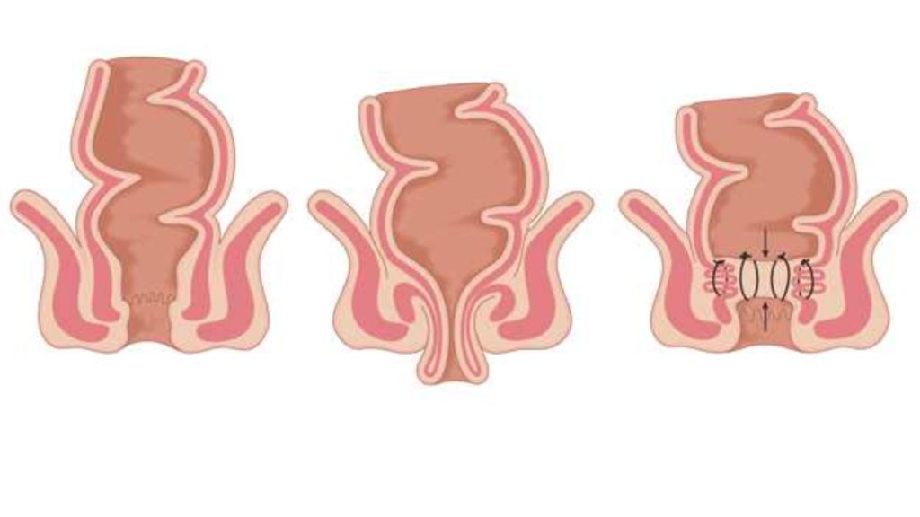 गुदा द्वार में सूजन आने के मुख्य कारण