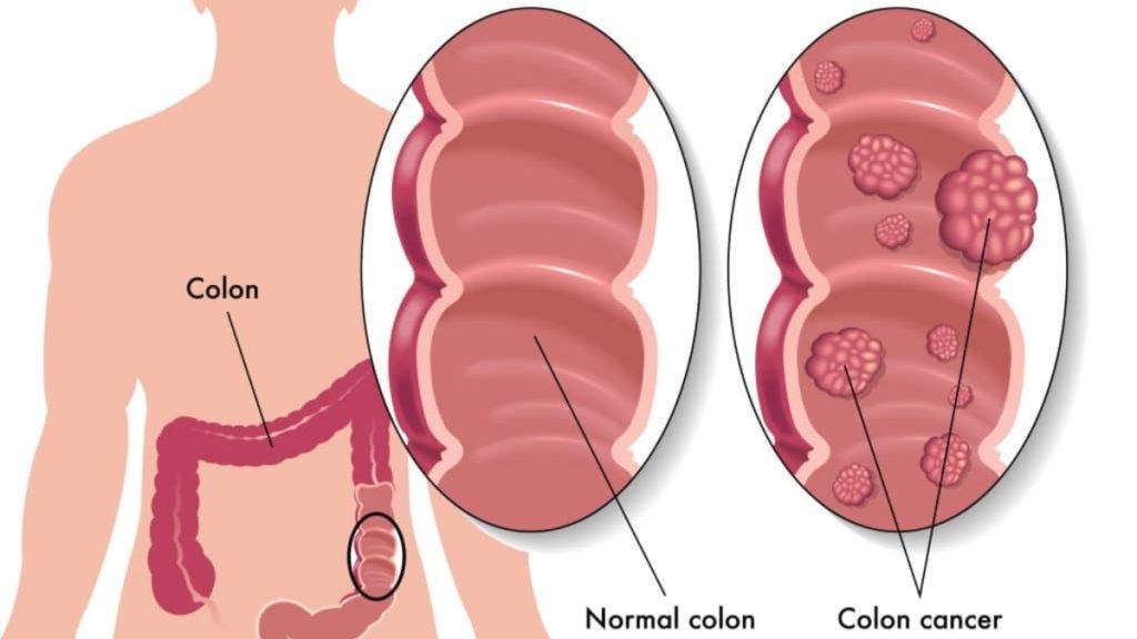 पाइल्स कैंसर के शुरुआती लक्षण क्या हैं