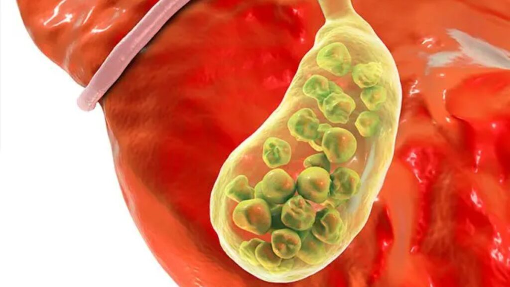 🟡 गॉल ब्लैडर स्टोन क्या होता है